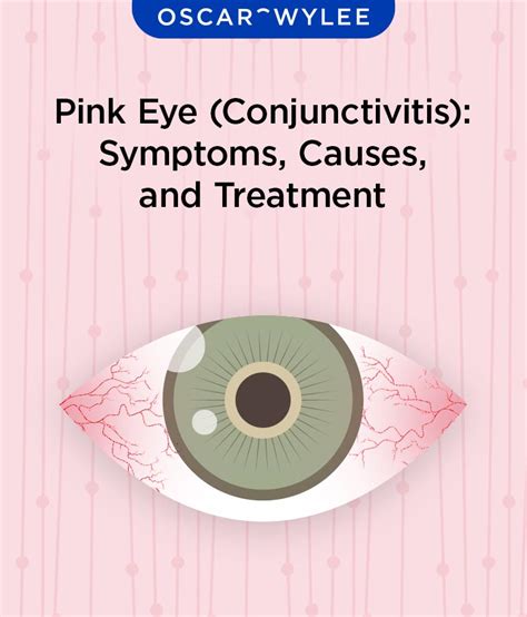 Pink Eye Conjunctivitis Treatment And Diagnosis Off