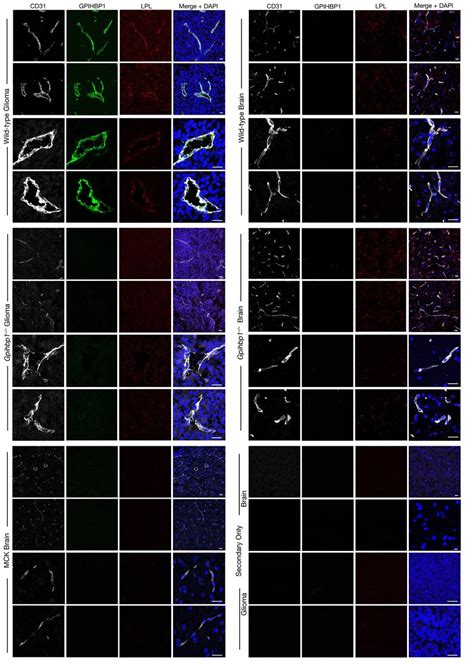 Figure Supplement 5 LPL Colocalizes With GPIHBP1 In Glioma