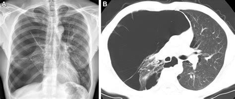 Lung Hyperlucency Chest