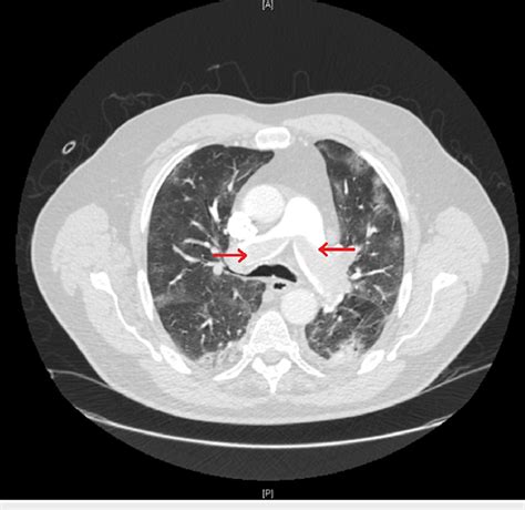 Computed Tomography Demonstrating Saddle Pulmonary Embolism At The Download Scientific Diagram