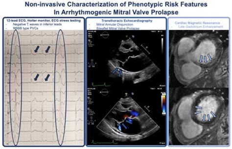 JCM Free Full Text Arrhythmic Mitral Valve Prolapse And Sports