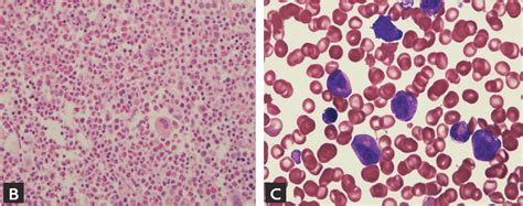 Figure 2 From Loeffler Endocarditis In Chronic Eosinophilic Leukemia