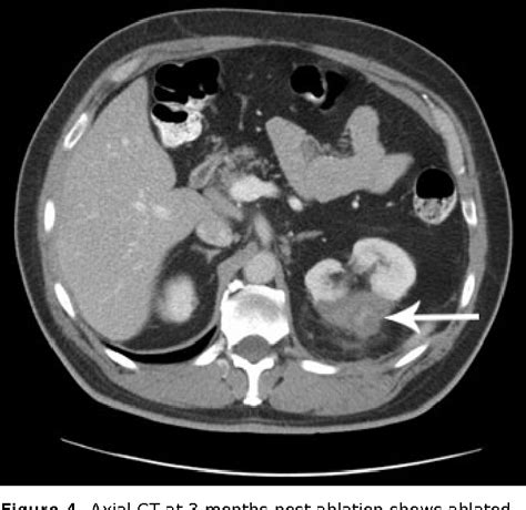 Figure From Percutaneous Image Guided Thermal Ablation Of Renal