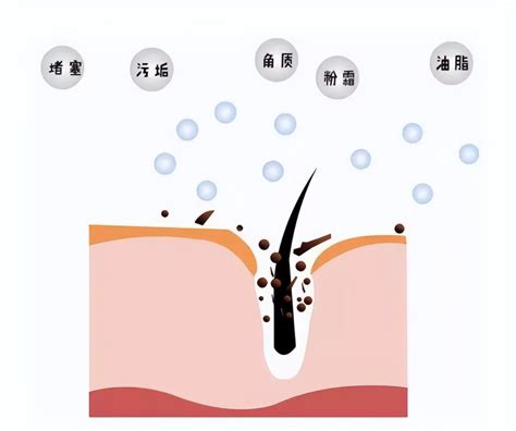 不同部位长痘原因，别再被谣言骗啦！腾讯新闻