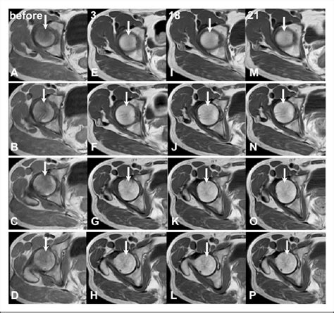 Figure 2 From Complete Resolution Of Avascular Necrosis Of The Human