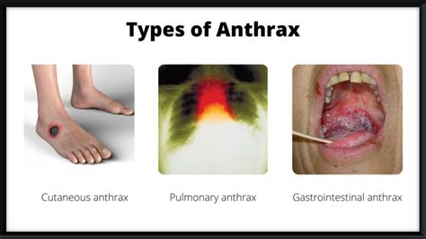 What Are The Causes, Symptoms, And Treatment Of Anthrax?