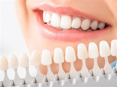 How Much Does Teeth Whitening Cost