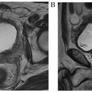 Pelvic Magnetic Resonance Imaging A Axial B Sagittal Showing