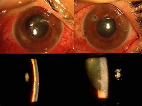 Top Slit Lamp Photograph Of The Both Eyes At Presentation Showing Download Scientific Diagram