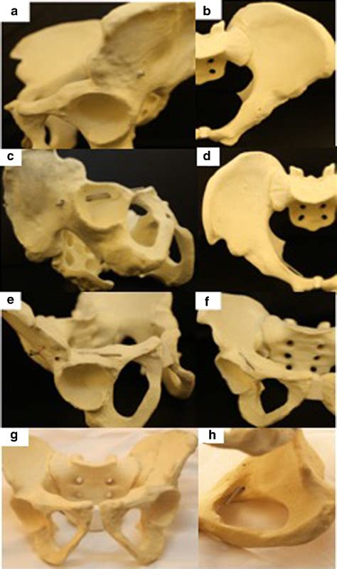 The Obturator Oblique And Iliac Oblique Outlet Views Predict Most