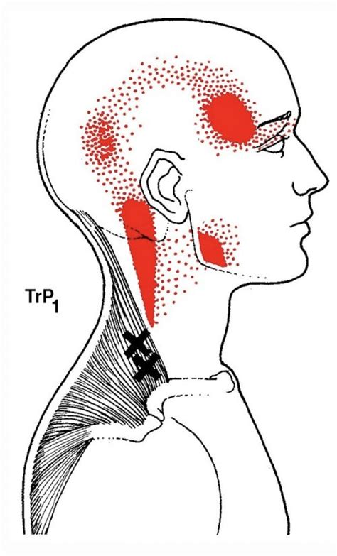 Cervicogenic Headache Exercises The Game Plan Physical Therapy