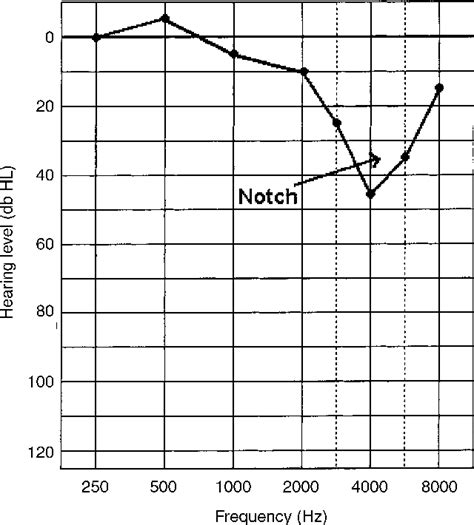 Figure 1 From Guidelines On The Diagnosis Of Noise Induced Hearing Loss