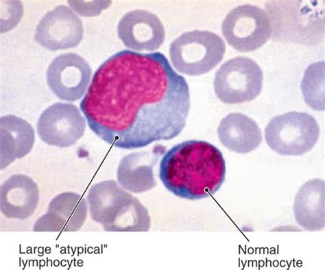 Infectious Mononucleosis, Epstein-Barr Virus Infections | Diseases ...