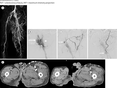 PDF Ilio Iliac Arteriovenous Fistula With May Thurner Syndrome A