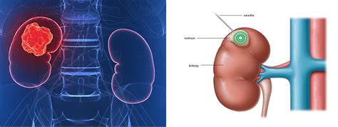 Kidney Cancer Varicose Veins Vascular Surgeon Stroke Dvt Leg