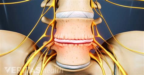 Types Of Back Pain