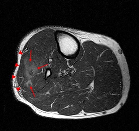 Compartments of leg radiology - smswest