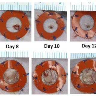 Gross Images Of Full Thickness Splinted Wounds In A Diabetic Murine