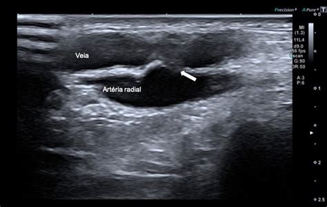 Av Fistula Groin Ultrasound