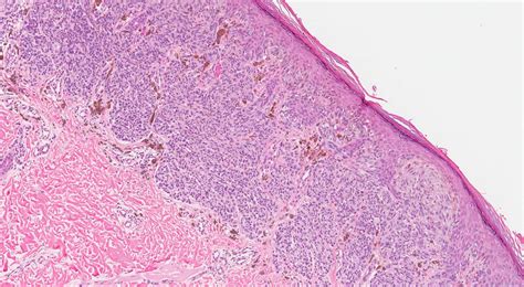 Spitz nevus | Ottawa Atlas of Pathology