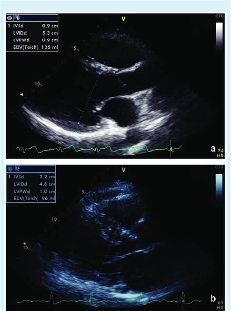 Echocardiographic Measurements Of The Interventricular Septal Thickness