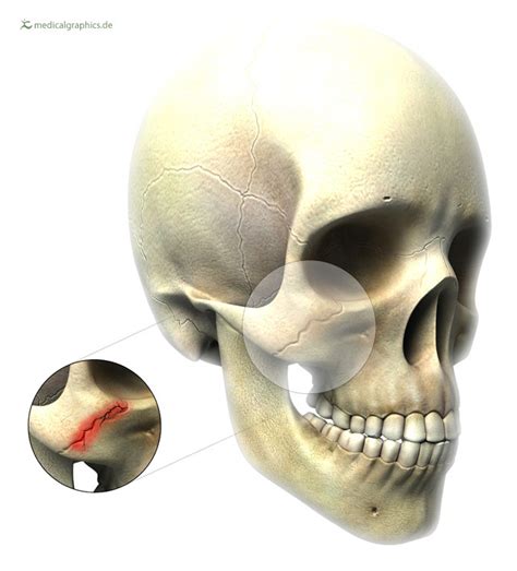 Illustration Jochbeinfraktur Cheekbone Fracture