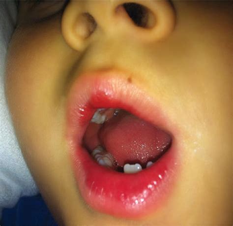 Scielo Brasil Extensive Cervical Lymphadenitis Mimicking Bacterial