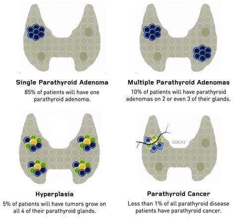 Hyperparathyroidism Causes And Treatment Options Dr Babak Larian