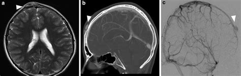 Pediatric Vascular Malformations Radiology Key