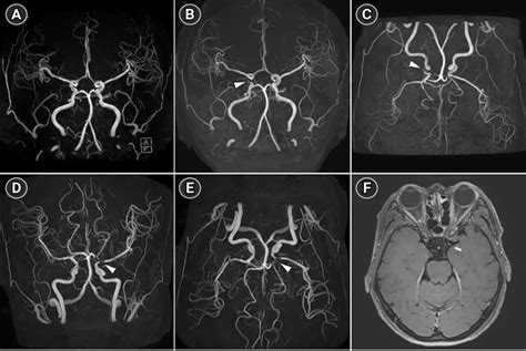 Brain Magnetic Resonance Angiography MRA And High Resolution Magnetic