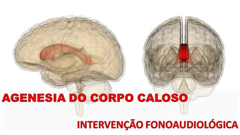 Agenesia Do Corpo Caloso YouTube