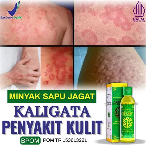 Jual Minyak Gatal Gatal Di Seluruh Badan Terbukti Khasiatnya