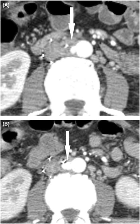 A Enhanced Computed Tomography Scan Of A 45‐year‐old Man On Hospital Download Scientific