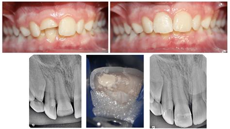 Tratamientos Y Casos Cl Nicos Endodoncia Y Traumatolog A Cl Nica Endo