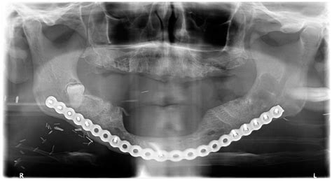 Radicular Cyst Radiology