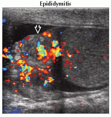 Da Db Extratesticular Solid Mass Ffu Abdominal Key