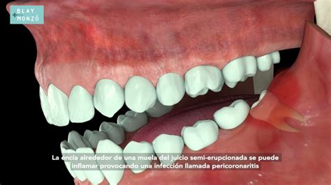 Muelas de juicio Todo lo que tienes que saber Clínica Dental Blay Monzo