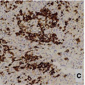 a-e Retroperitoneal lymph node biopsy. H&E stained core biopsy of the ...