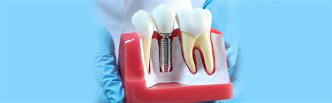 What Is The Recovery Process For Dental Implants Blog