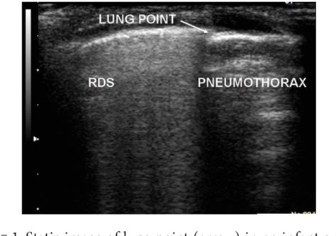 Pdf Lung Ultrasound Diagnostic Accuracy In Neonatal Pneumothorax