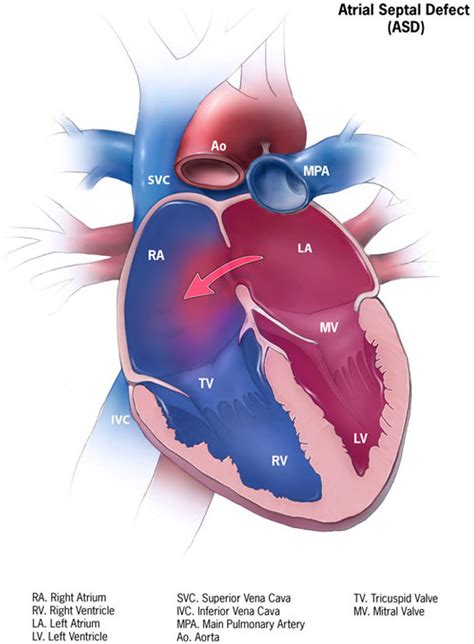 Atrial Septal Defect Wikipedia