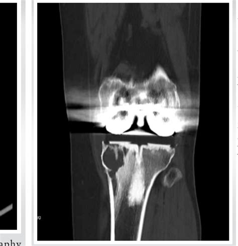 Figure 4 From Tibial Component Revision Arthroplasty Using Porous