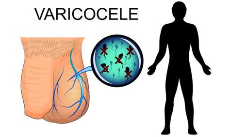 Comment Traiter Le Varicoc Le Naturellement