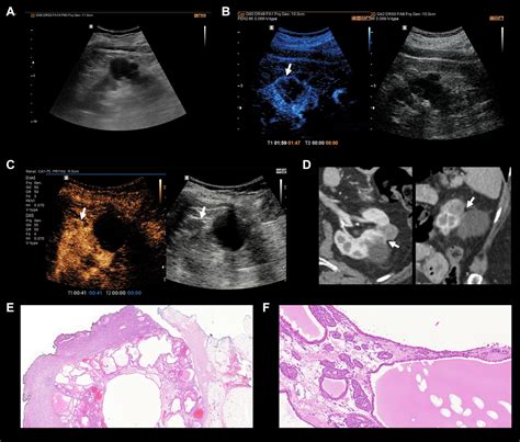 predictive power  bosniak    cystic renal lesion