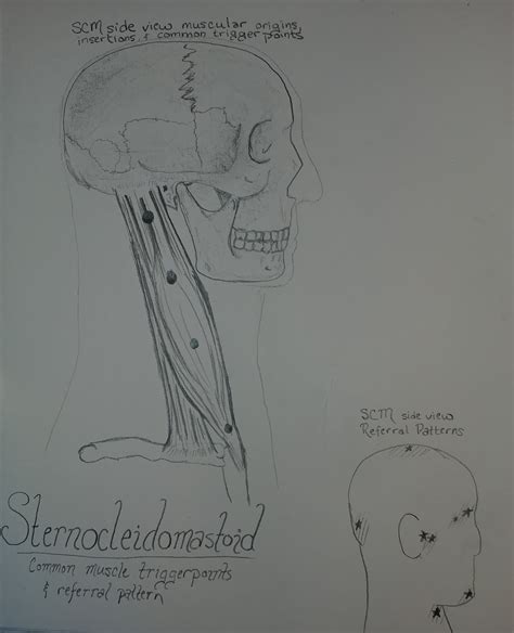 Trigger Point: Sternocleidomastoid