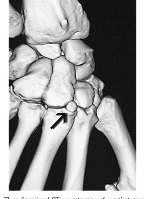 The Preliminary Results Of Treatment Of Symptomatic Carpal Boss By