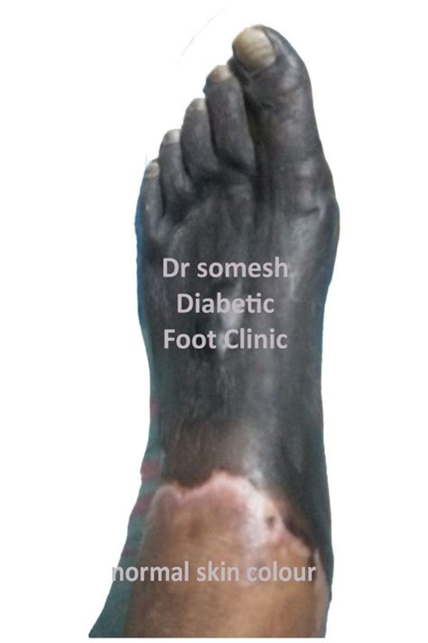 Pics Of Gangrene On The Foot Online