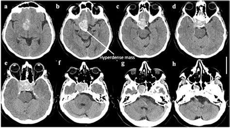 Coronal Sections Of The Progress Non Contrast Ct Brain Labelled A To H