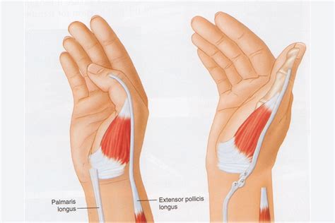 Tendon Transfers