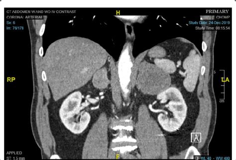 Ct Scan Demonstrating Bilateral Adrenal Masses 76 Cm On The Left And